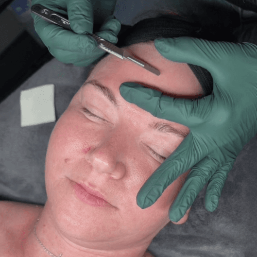 Dermaplaning & Microneedling COMBO at It's Aesthetically Jess in Swansea, IL